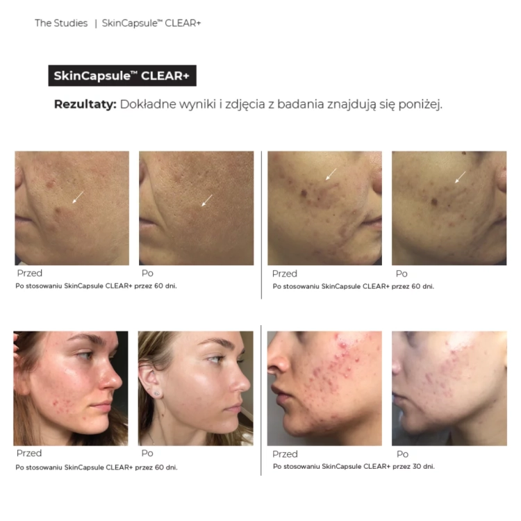 Hush &amp; Hush SkinCapsule CLEAR+ Suplement na Trądzik Wegański Wsparcie Skóry 60 kapsułek